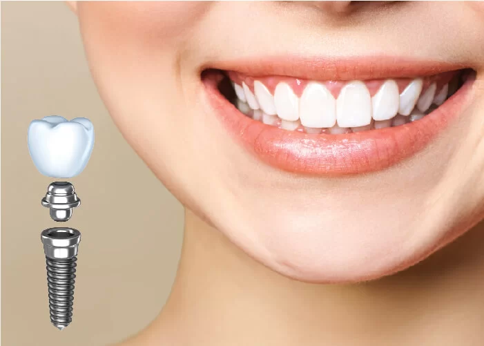 Nha Khoa Ngọc - phòng khám trồng răng implant Thái Bình chất lượng tốt
