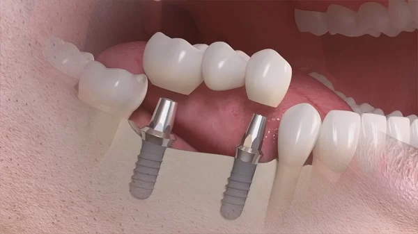 Tiêu chí lựa chọn địa chỉ uy tín trồng răng implant tại Thái Bình