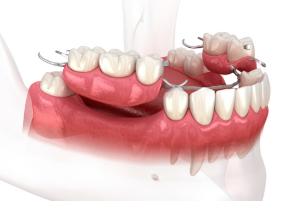 Địa chỉ nha khoa trồng răng implant tại Thái Bình uy tín nhất