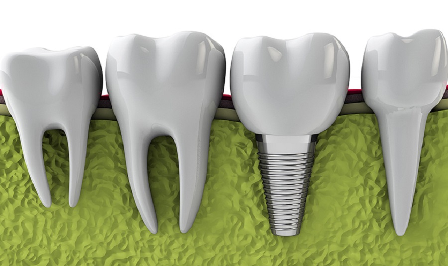 Địa chỉ trồng răng implant Thái Bình uy tín giá rẻ