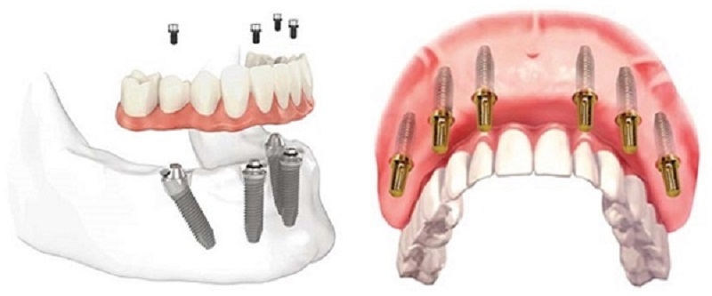 Ưu điểm của trồng răng implant all on 4 Thái Bình