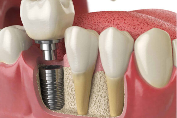Địa chỉ nha khoa trồng răng implant tại Thái Bình uy tín nhất