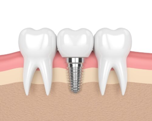 Trồng răng hàm Thái Bình mang lại nhiều ưu điểm