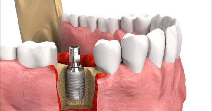 Nha khóa trồng răng implant tại Thái Bình được đánh giá cao nhất