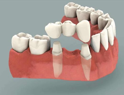 Phương pháp trồng răng hàm Thái Bình an toàn hiệu quả