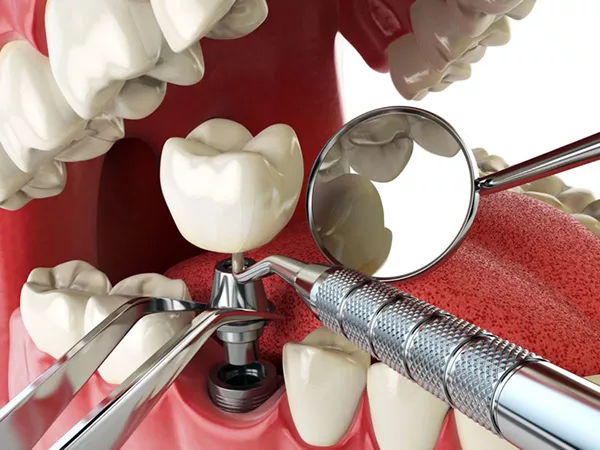 Trồng răng implant Thái Bình phương pháp trồng răng hoàn hảo nhất