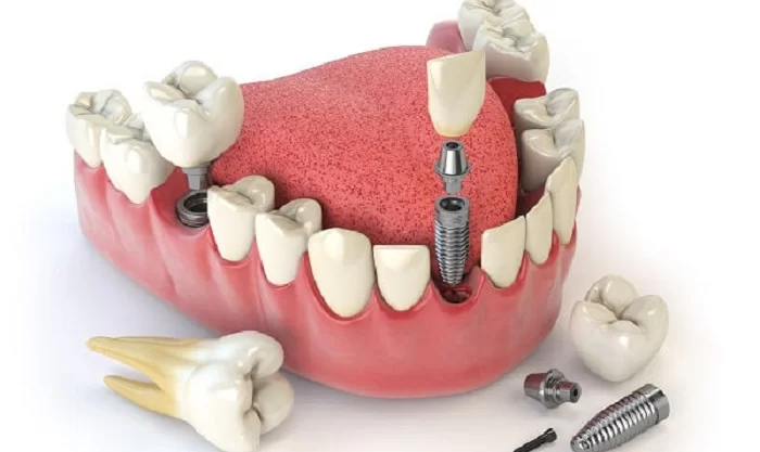 Trồng răng implant Thái Bình - giải pháp hiệu quả số 1 hiện nay