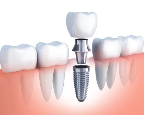 Phòng khám nha khoa trồng răng implant Thái Bình uy tín chất lượng