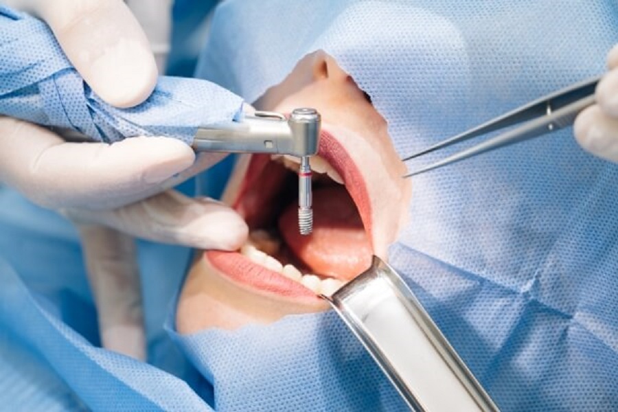 Trồng răng implant Thái Bình - Nguyên nhân gây mất răng hàm