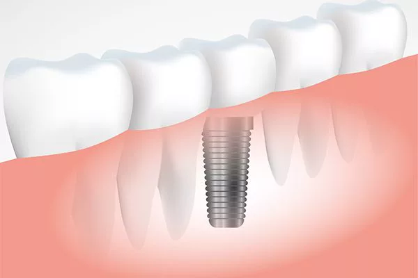 Trồng răng implant Thái Bình công nghệ mới, an toàn, không đau