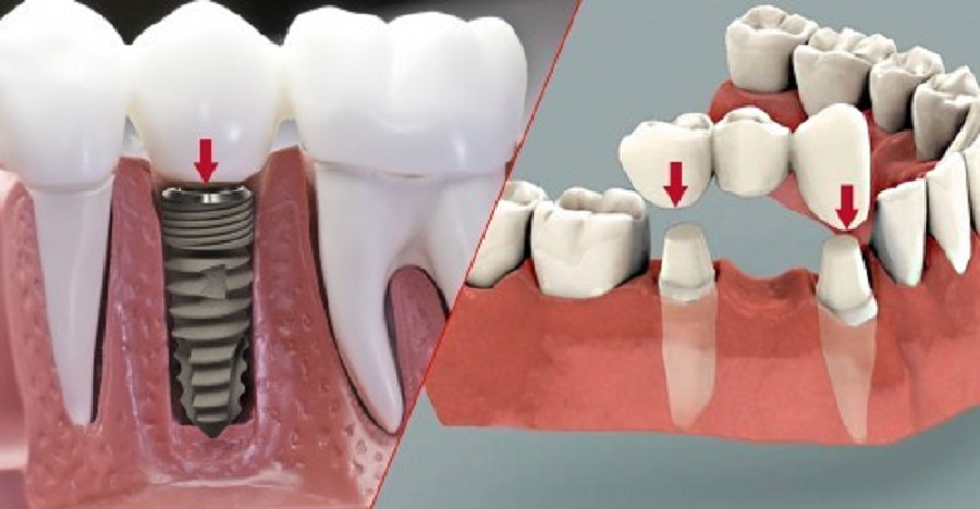 Trồng răng implant Thái Bình công nghệ mới, an toàn, không đau
