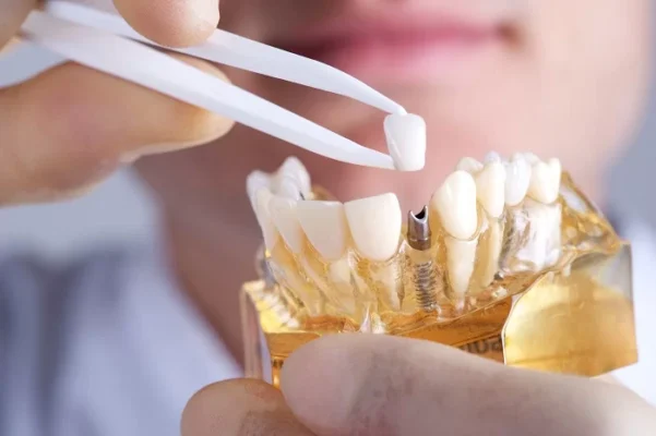 Tìm hiểu trồng răng implant Thái Bình phù hợp với đối tượng nào