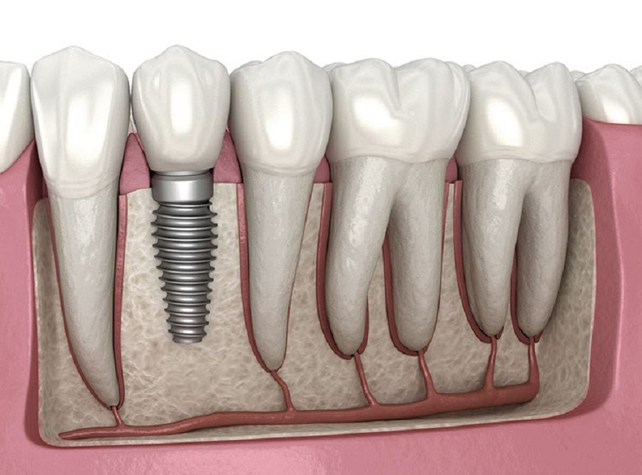 Trồng răng implant tại Thái Bình uy tín chất lượng bạn nên chọn