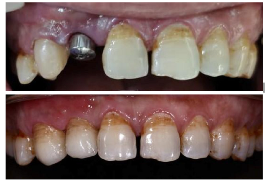 Phương pháp trồng răng hàm Thái Bình an toàn hiệu quả