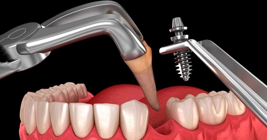 Vì sao nên trồng răng implant tại Thái Bình