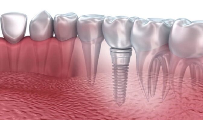 Yếu tố quyết định đến trồng răng implant tại Thái Bình