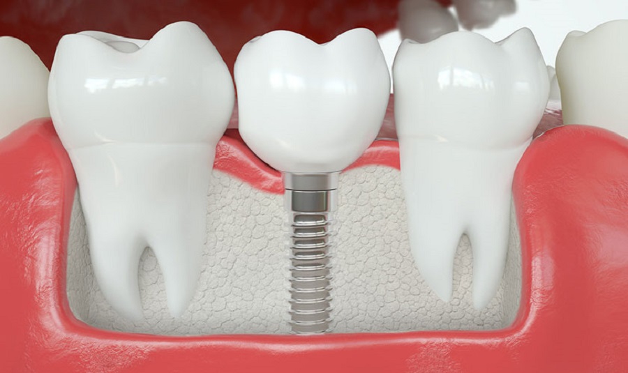 Nguyên nhân răng hàm bị sâu và phương pháp trồng răng hàm Thái Bình