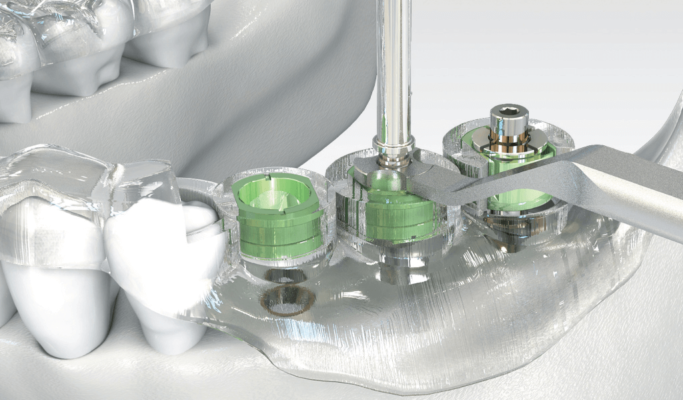 Tìm hiểu máng hướng dẫn phẫu thuật implant tại Thái Bình