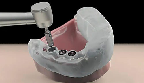 Quy trình trồng răng implant bằng máng hướng dẫn tại Thái Bình