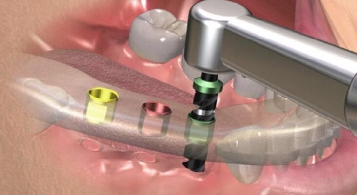Ưu điểm nổi bật trồng răng implant bằng máng hướng dẫn tại Thái Bình