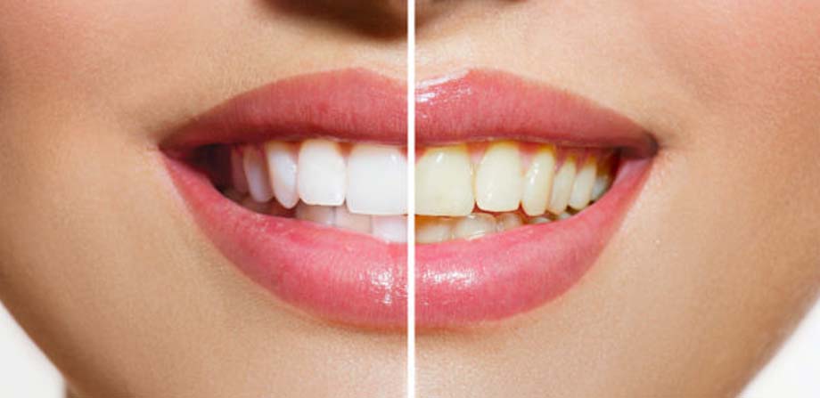 Công nghệ Smile Design - Thiết kế nụ cười Thái Bình chuẩn đẹp tự nhiên