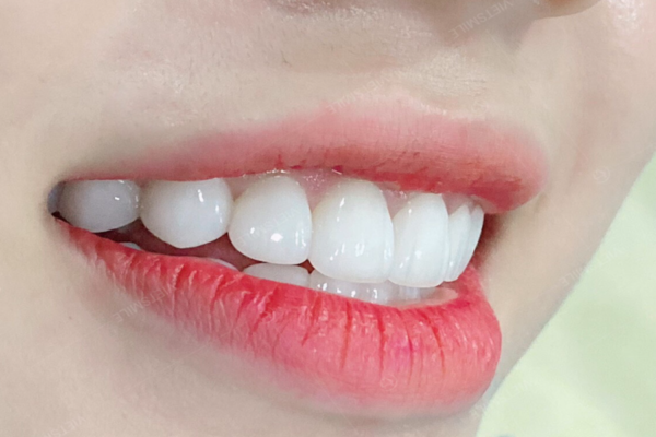 Tìm hiểu công nghệ thiết kế nụ cười Thái Bình hiện nay
