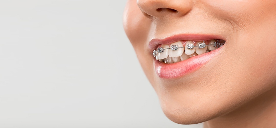 Ưu điểm của thiết kế nụ cười tại Thái Bình mang lại 2 Thiết kế nụ cười phù hợp với những ai?