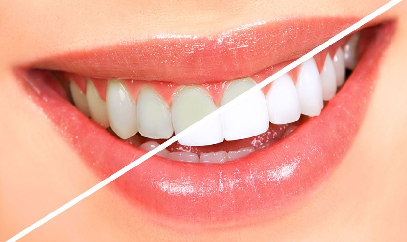 Răng sứ thẩm mỹ Thái Bình - Giải pháp phục hình răng hiện nay