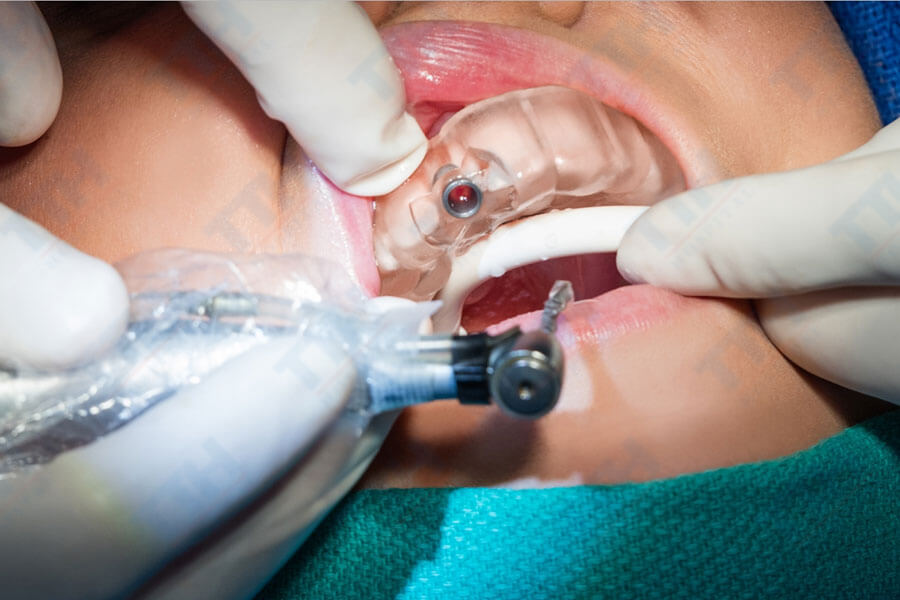 Giải pháp tối ưu trồng răng implant bằng máng hướng dẫn tại Thái Bình