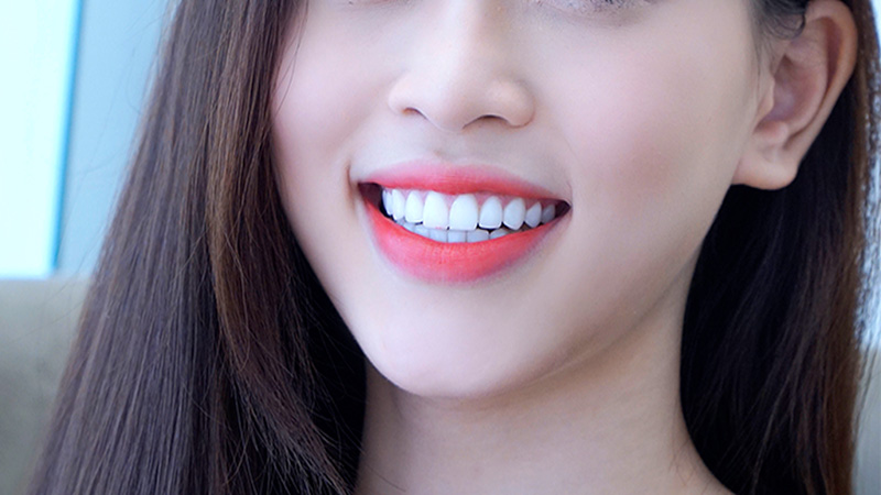 Ưu điểm của thiết kế nụ cười tại Thái Bình mang lại 3 Ưu điểm của thiết kế nụ cười tại Thái Bình mang lại