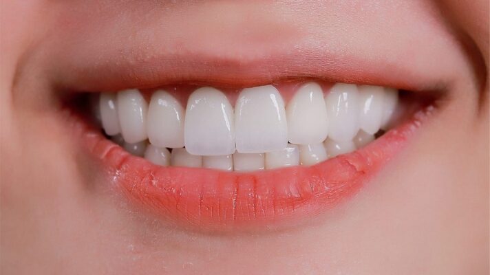 Quy trình thiết kế nụ cười tại Thái Bình bằng công nghệ Smile Design