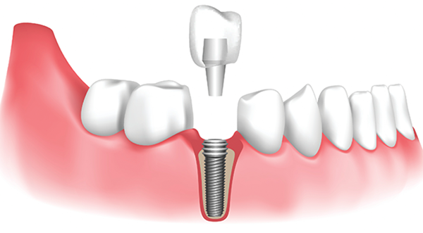 Xu hướng trồng răng implant bằng máng hướng dẫn tại Thái Bình hiện nay 1 Các bước chính trong quy trình trồng răng implant bằng máng hướng dẫn