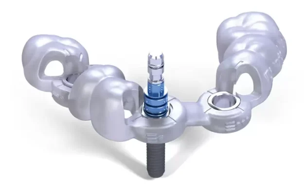 Máng hướng dẫn phẫu thuật cấy ghép implant tại Thái Bình