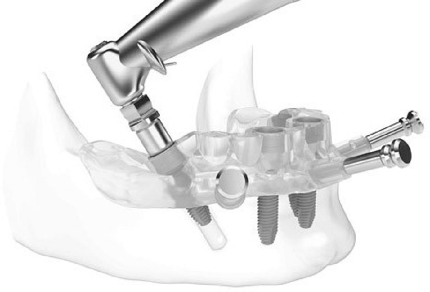 Giải pháp tối ưu trồng răng implant bằng máng hướng dẫn tại Thái Bình