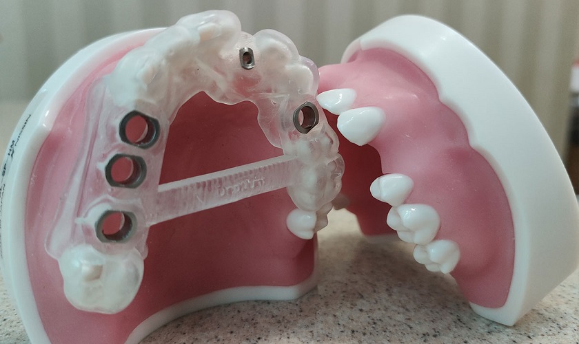 Máng hướng dẫn phẫu thuật cấy ghép implant tại Thái Bình