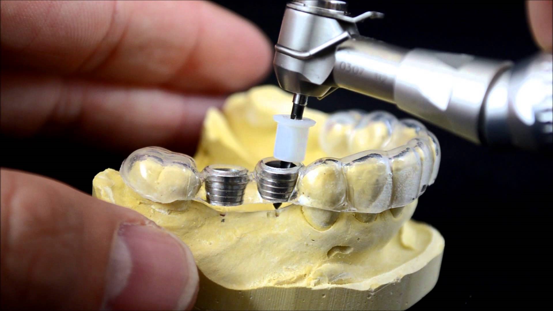 Ưu điểm của máng hướng dẫn phẫu thuật cấy ghép implant tại Thái Bình