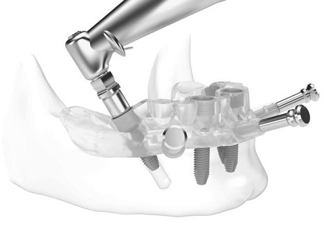 Phương pháp trồng răng implant bằng máng hướng dẫn Thái Bình
