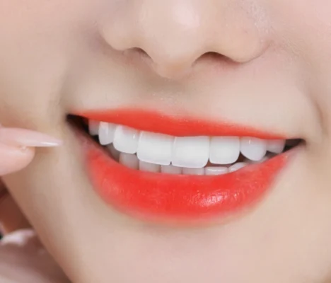 Quy trình bọc răng sứ thẩm mỹ tại Thái Bình