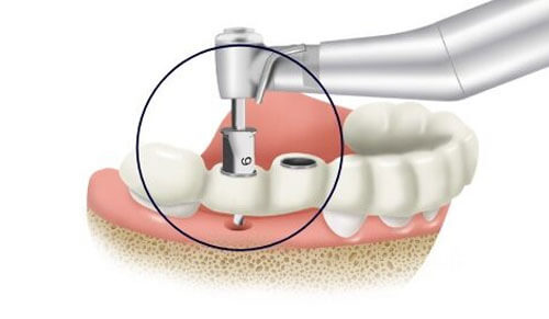 Xu hướng trồng răng implant bằng máng hướng dẫn tại Thái Bình hiện nay