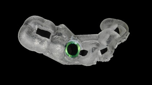 Vai trò của trồng răng implant bằng máng hướng dẫn Thái Bình