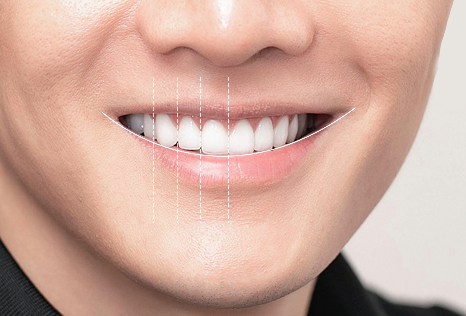Quy trình thiết kế nụ cười tại Thái Bình bằng công nghệ Smile Design