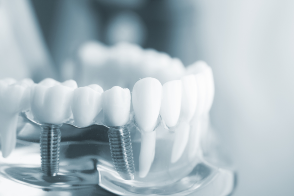 Trồng răng implant bằng máng hướng dẫn Thái Bình