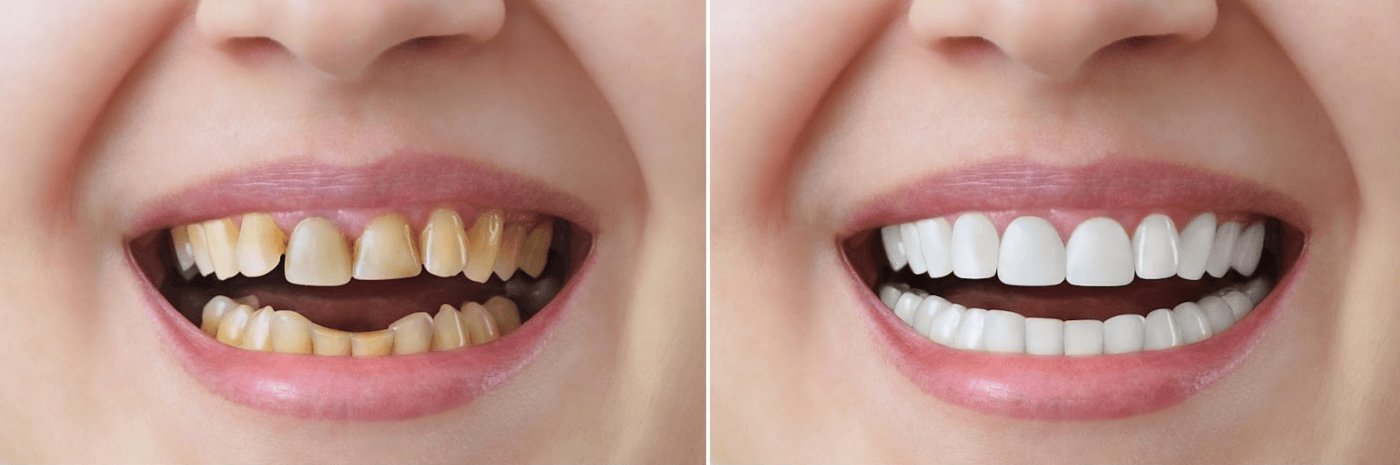 Các trường hợp nên bọc răng sứ hiện nay