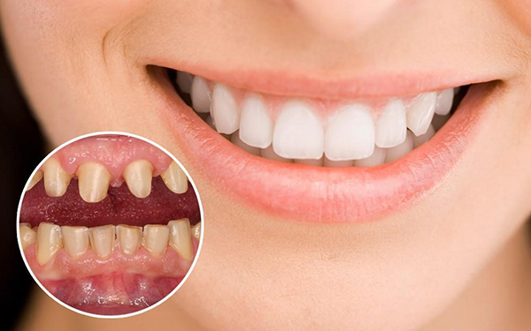 Những điều cần biết khi bọc răng sứ Thái Bình