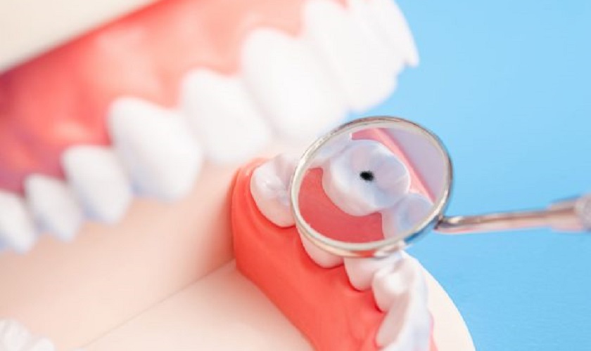 Tìm hiểu quy trình bọc răng sâu Thái Bình