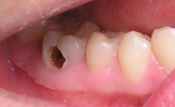 Tìm hiểu chi phí bọc răng sâu Thái Bình