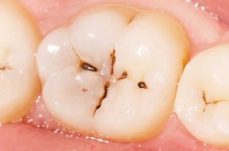 Tìm hiểu chi phí bọc răng sâu Thái Bình
