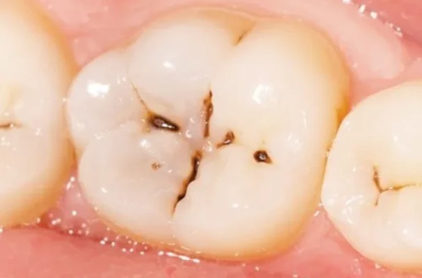 Quy trình bọc răng sâu Thái Bình như thế nào