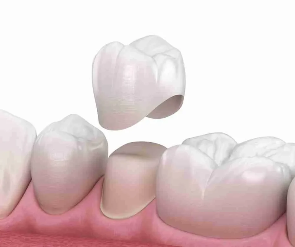 Quy trình bọc răng sâu Thái Bình được thực hiện bởi bác sĩ có nhiều kinh nghiệm