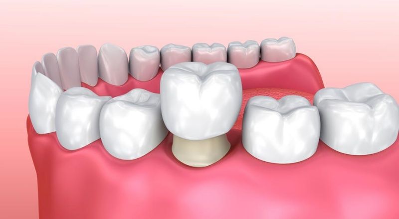 Ưu điểm khi bọc răng sứ cho răng sâu